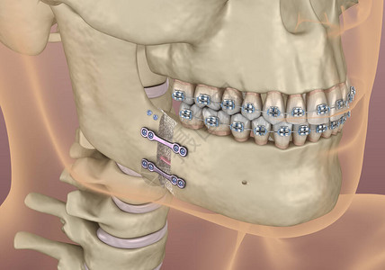 人工推进手术医学上准确的牙科3D插图片