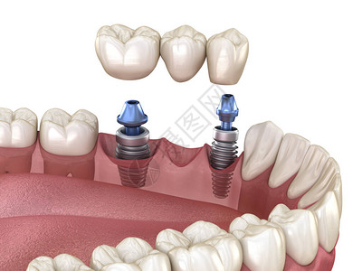 用植入器支持的牙科桥医学上准确的3D人类牙齿和图片