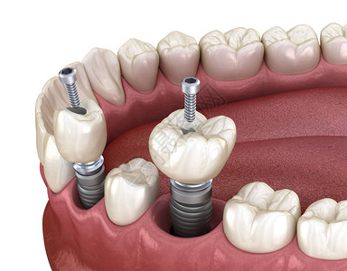 在植入固定螺丝固定装置上安装前摩拉和莫拉尔牙冠3D图片