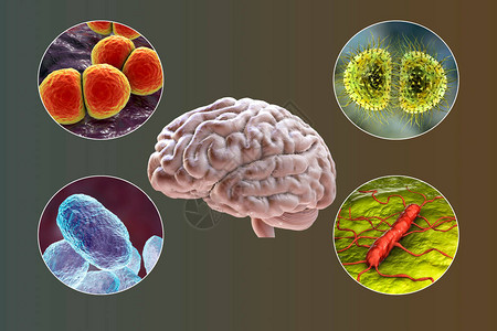 细菌脑膜炎的病因背景图片