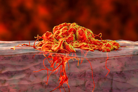入侵癌症增长3D图例显示肿瘤侵图片