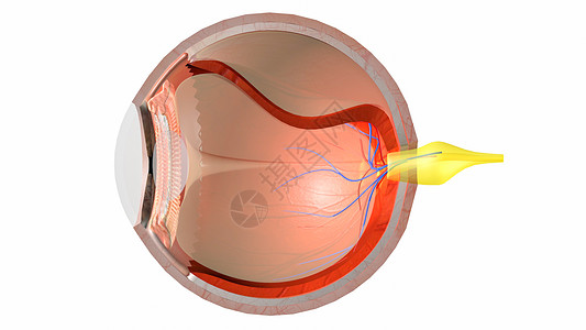 视网膜脱落gltf晶状体高清图片