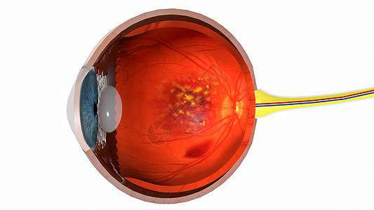 湿性黄斑变性高清图片