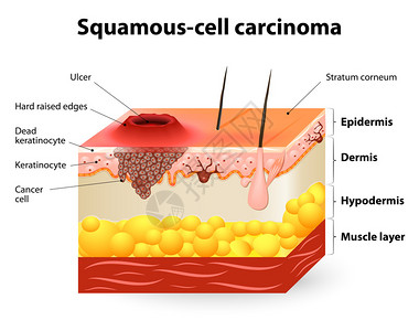 鳞状细胞癌图片