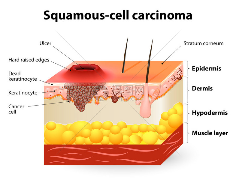 鳞状细胞癌图片