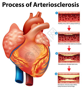 动脉粥样硬化的过程背景图片