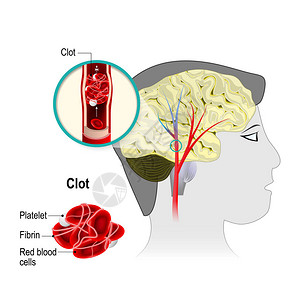 脑梗塞脑中风阻塞是由脑动脉中形成的血凝块引起的血细胞阻塞血流图片