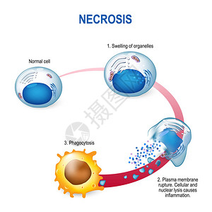 坏死病理细胞导致活组织中细胞过早死背景图片
