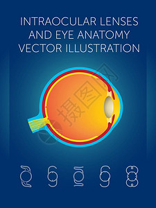 人工晶状体和眼解剖矢量图图片