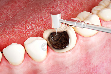 根管治疗三维蛀牙打磨场景设计图片