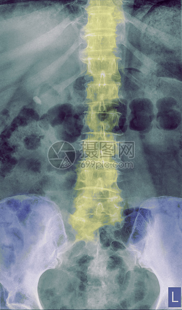 77岁腰椎前视x线图片