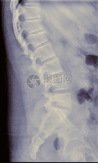 14岁男性左二椎体侧视压缩性骨折的X线表现图片