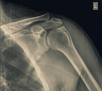 40岁男性锁骨骨折患者肩位X线平片图片