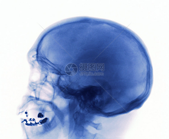 头骨X光检查图片