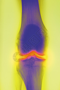 膝盖骨X光片图片