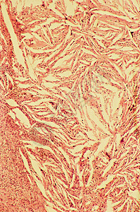 乳腺炎胆固醇结晶图片