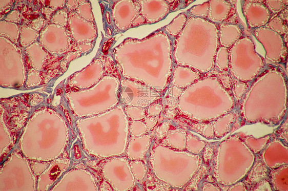 甲状腺胶体滤泡图片