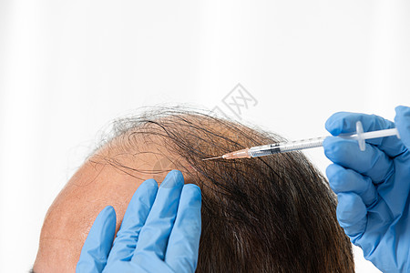 中年男性植发手术背景图片
