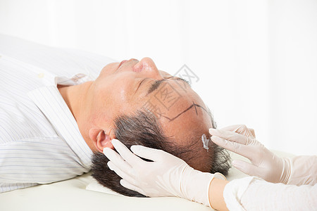 中年男性植发手术背景图片