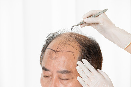 中年男性植发手术高清图片