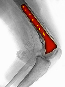 骨折断裂的大腿膝部修补X光图片
