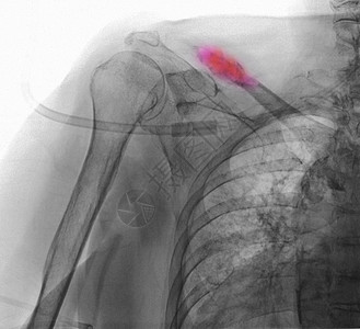 X光乳腺癌图片