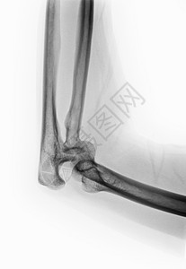 手肘骨折X射线图图片