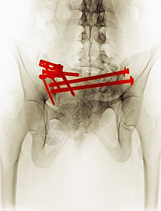X光显示骨盆骨折手术修复图片