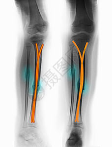 X射线显示甲状腺和纤维骨折图片