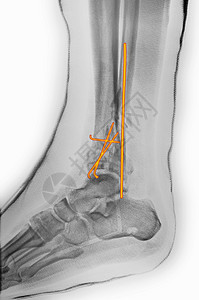 手术后脚踝骨折X光图片