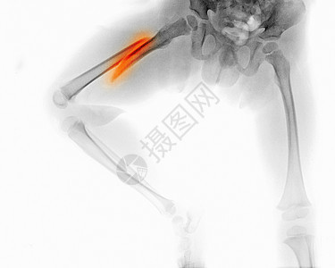 X光片显示一名3岁男孩腿骨折图片
