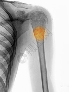 X射线显示直径角的humerus骨折图片