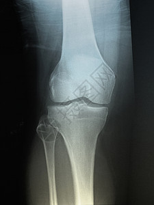 一名58岁男子的正常膝盖X光图片