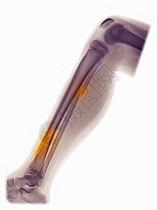 显示纤维骨折和蒂比亚的X光腿图片