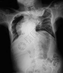 骨质疏松的胸腔X光显示图片