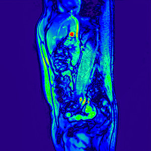 对60岁患有肾结石的男病人侧视图abdomenMRI扫描图片