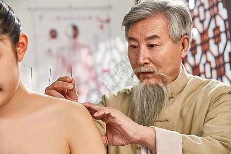 老中医对病人肩膀进行针灸治疗图片
