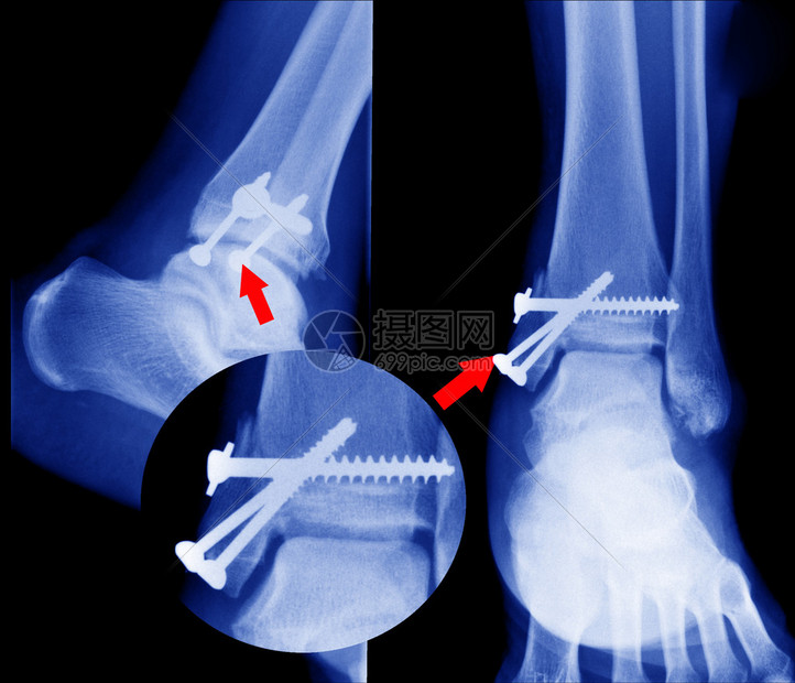 射线骨折图片
