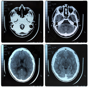 人脑颅骨的医学X射线成像图片