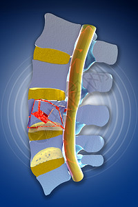 脊柱骨髓外伤骨折椎体爆裂骨图片