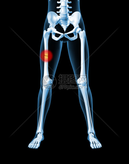3D骨折的女医生骨骼折突图片