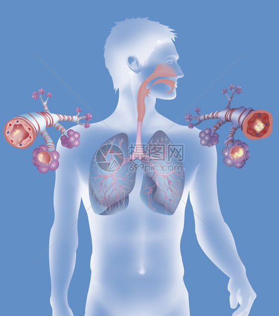 在哮喘病发作期间健康的支气管左和图片