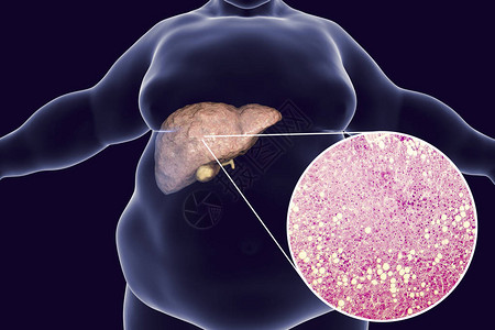 患有脂肪肝脏3D图解和肝胃病照片显微镜的肥胖男子非酒精脂肪肝病图片