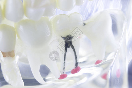 牙根管牙医齿模型特写图片
