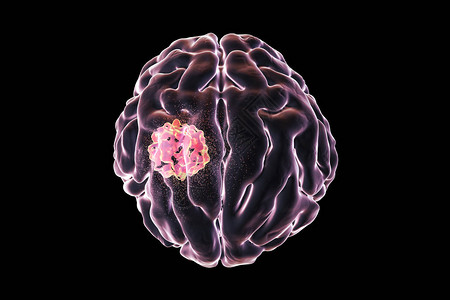 脑肿瘤的破坏3D图解脑癌治疗的概图片