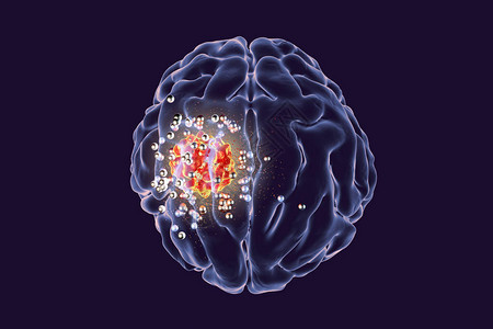 纳米粒子对脑肿瘤的破坏图片