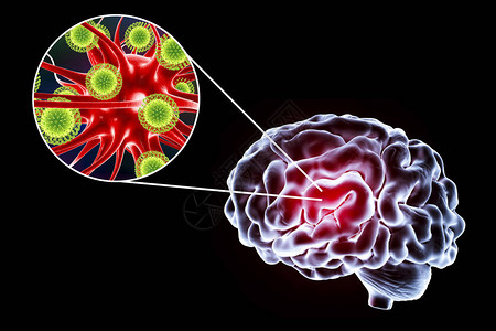 3D插图显示大脑和突变神经元图片