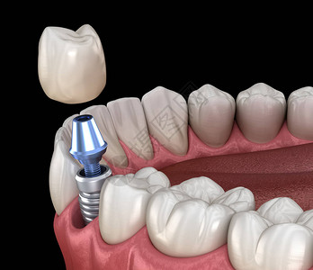 种植体修复前磨牙人类牙齿和假牙概念的医学上准确的图片