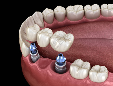用植入器支持的牙科桥医学上准确的3D人类牙齿和图片