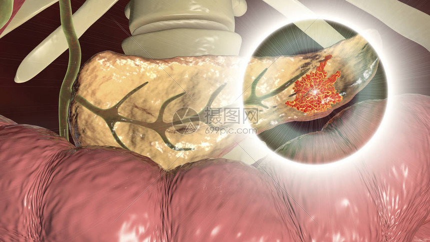 胰腺癌胰腺恶肿瘤3D插图图片